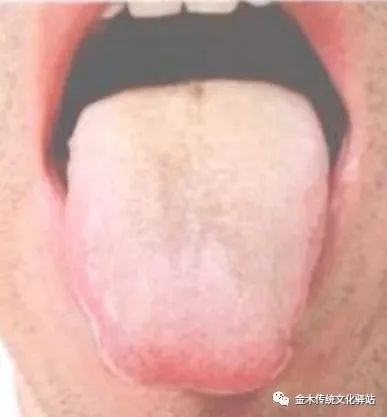 Tongue Diagnosis in Traditional Chinese Medicine: Characteristics of Tongue Coating