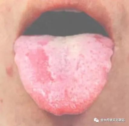 Tongue Diagnosis in Traditional Chinese Medicine: Characteristics of Tongue Coating