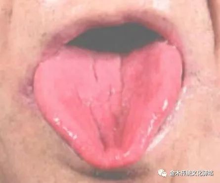 Tongue Diagnosis in Traditional Chinese Medicine: Characteristics of Tongue Coating