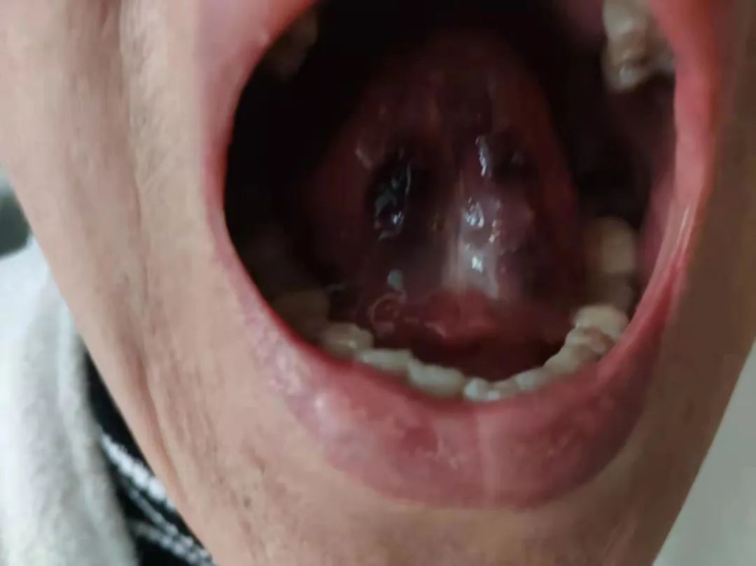 Sublingual Bloodletting to Alleviate Heart Meridian Stagnation