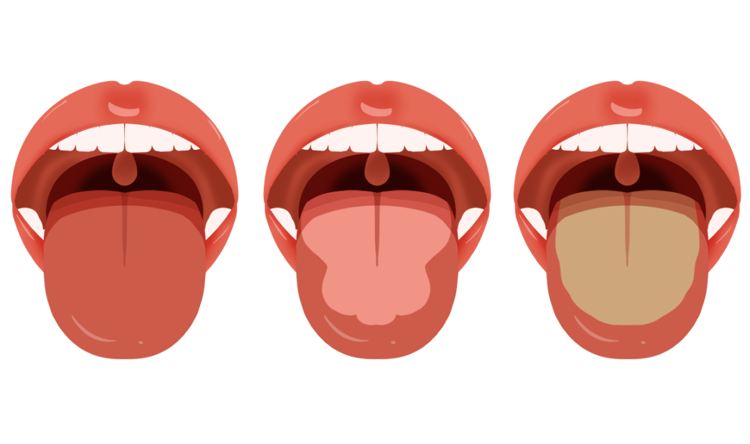 The Body Signals Illness: Understanding Tongue Diagnosis in TCM
