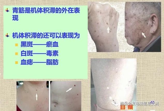 Expert Advice: Identifying Blood Stasis Diseases Through Visible Veins