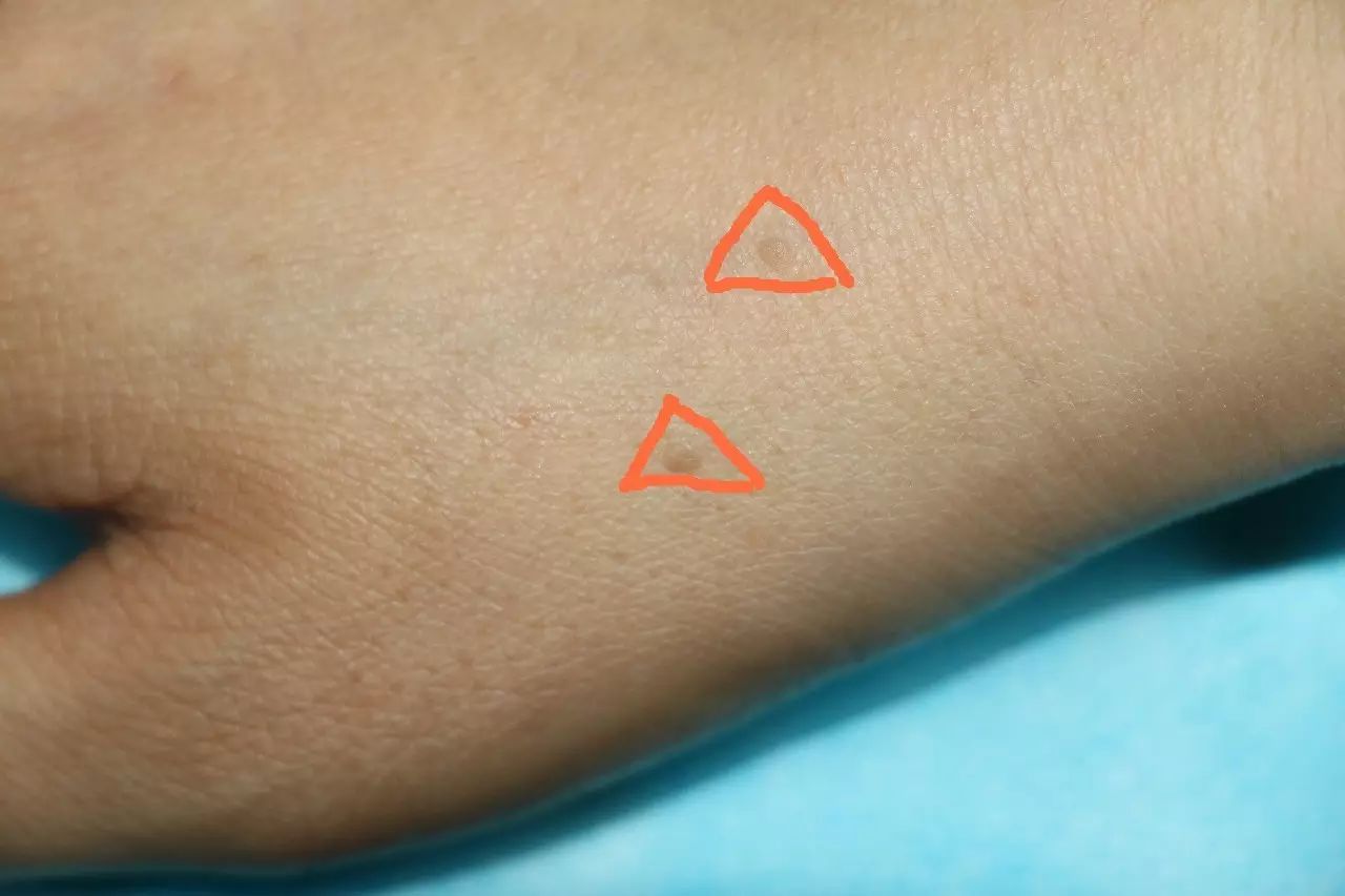 Fire Needle Therapy for Flat Warts
