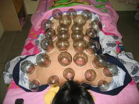 Techniques for Cupping Therapy