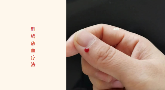 Traditional Chinese Medicine Therapy: Bloodletting Therapy