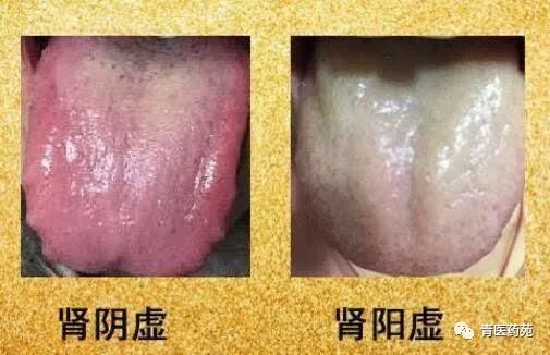 Definition, Symptoms, Treatment Principles, and Basic Formulas for Kidney Yang Deficiency