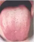 Comprehensive Guide to Tongue Diagnosis: Learn How Your Tongue Reflects Your Health!