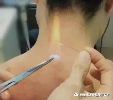 Fire Needle: An Evolution in Acupuncture Therapy