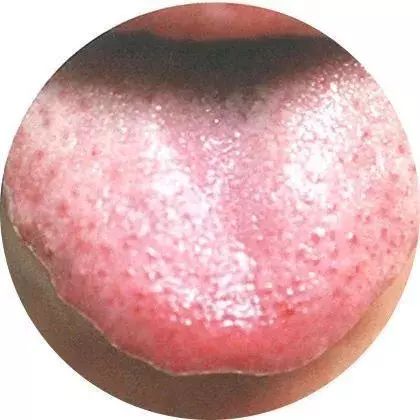 What Can Traditional Chinese Medicine Reveal Through Tongue Diagnosis?