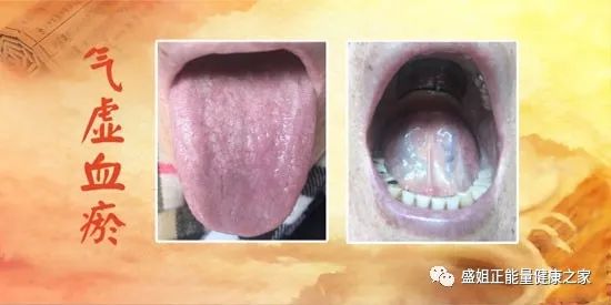 Symptoms of Qi Stagnation and Blood Stasis, and Their Regulation Methods