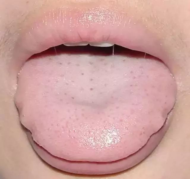 The Most Comprehensive Guide to Tongue Diagnosis! Master It and Become a Tongue Diagnosis Expert