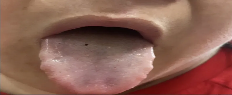 Traditional Chinese Medicine: Two Methods to Assess Blood Stasis and One Herbal Formula to Resolve It