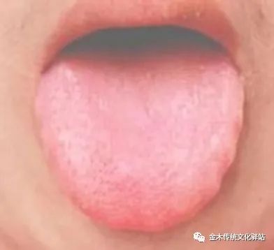 Tongue Diagnosis in Traditional Chinese Medicine: Characteristics of Tongue Coating