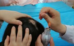 Fire Needle Therapy for Alopecia Areata in Traditional Chinese Medicine