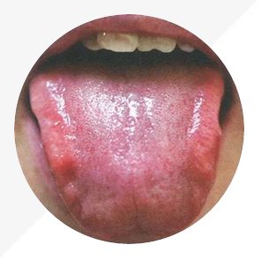 Understanding Tongue Diagnosis in TCM: Insights into Health from Tongue Appearance (Part 2)