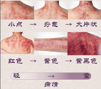 10 Gua Sha Techniques to Relieve Various Ailments Using a Spoon