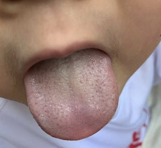 Analysis of Clinical Patterns and Treatments for Summer Damp-Heat Syndrome (6): Typical Damp-Heat Case Studies