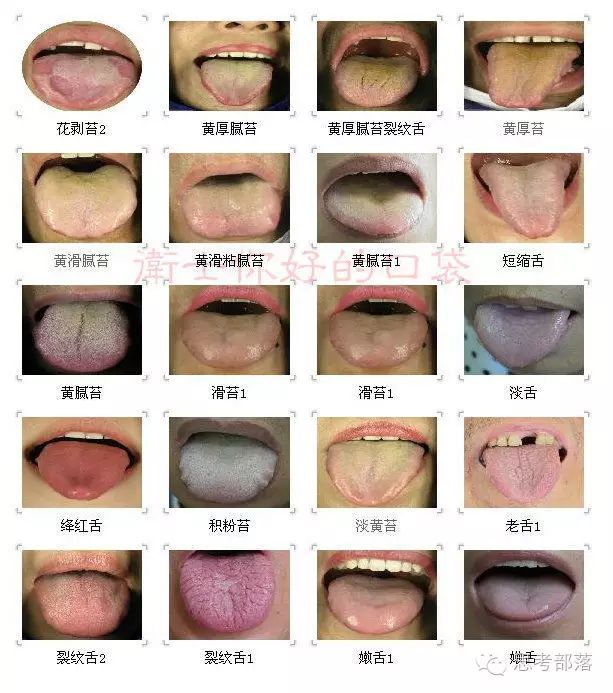 Comprehensive Guide to Tongue Diagnosis (8): 72 Types of Tongue Diagnosis Charts