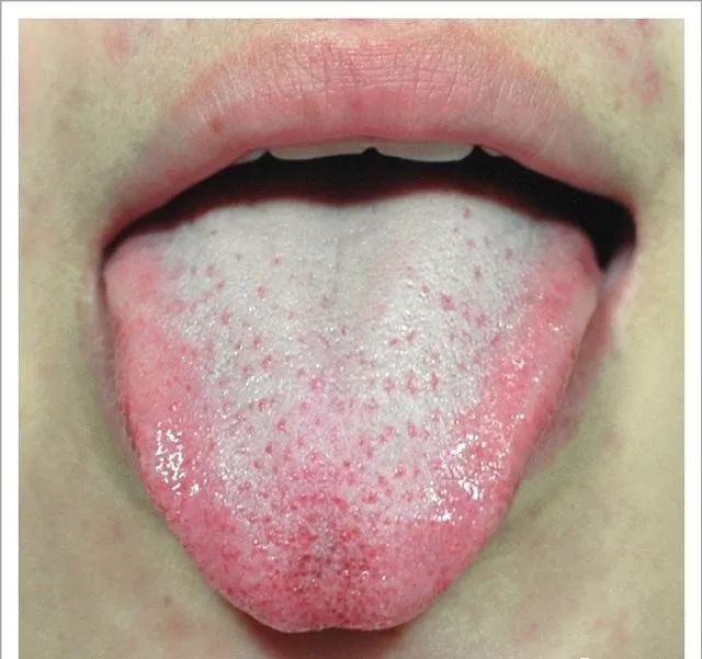 Traditional Chinese Medicine Tongue Diagnosis: 26 Clinical High-Definition Tongue Diagnosis Images with Analysis