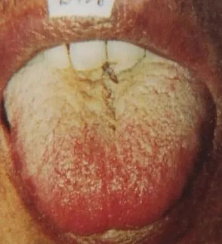 Comprehensive Guide to Tongue Diagnosis and Associated Conditions in TCM