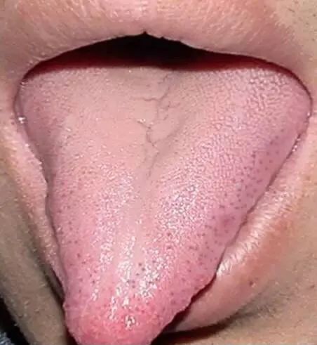 Tongue Diagnosis - Illustrated Guide to Tongue Manifestations