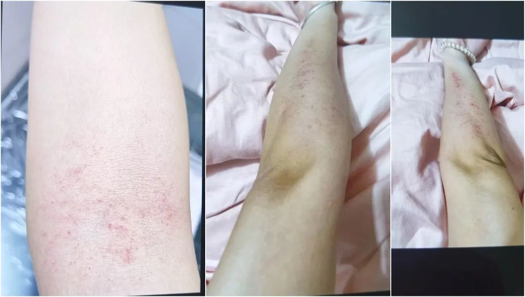 The Benefits of Gua Sha: A Personal Experience