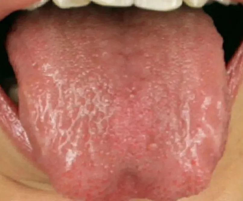 How Should Individuals with Yin Deficiency Nourish Themselves in Winter?