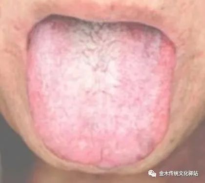 Tongue Diagnosis in Traditional Chinese Medicine: Characteristics of Tongue Coating