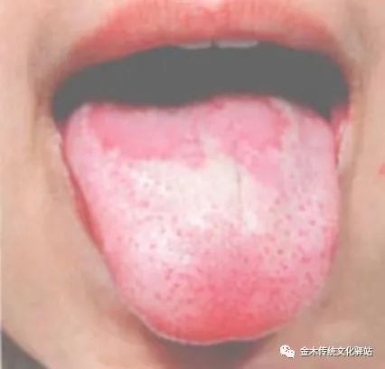 Tongue Diagnosis in Traditional Chinese Medicine: Characteristics of Tongue Coating