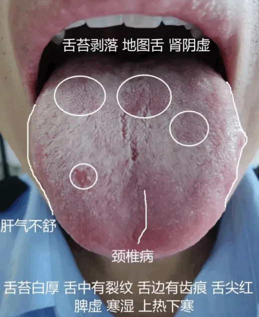 Analyzing Tongue Diagnosis: A Simple Approach to Understanding TCM