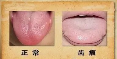 Seven Major Symptoms of Spleen and Stomach Yang Deficiency: How Many Do You Have?