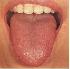 Understanding Disease Through Tongue Diagnosis in Traditional Chinese Medicine