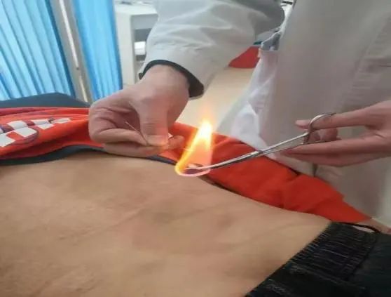 Understanding Fire Needle Therapy in Traditional Chinese Medicine