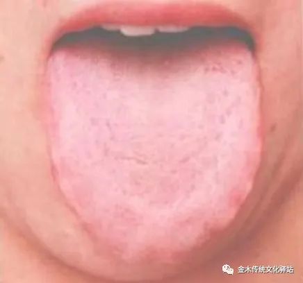 Tongue Diagnosis in Traditional Chinese Medicine: Tongue Coating