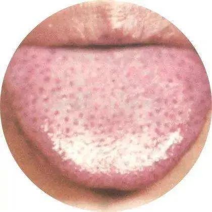 When Your Tongue Shows This Signal: Don't Delay!