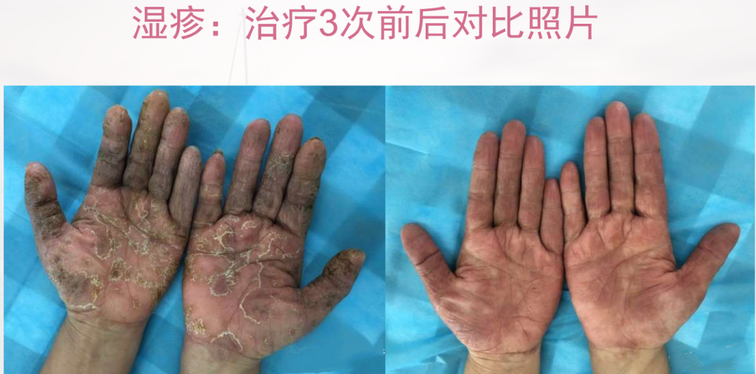Essential Knowledge of Fire Needle Therapy in Dermatology