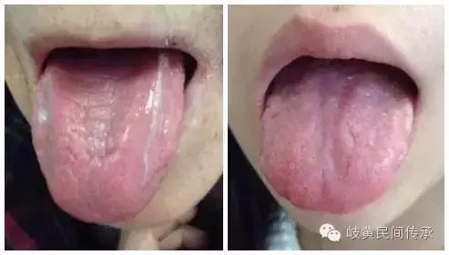Understanding Your Body Constitution Through Tongue Coating Observation