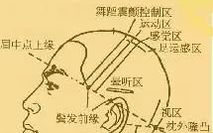 Understanding Electroacupuncture Therapy