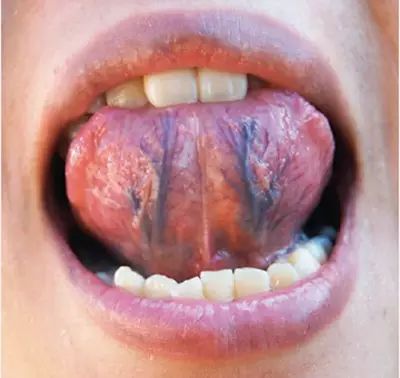 Blood Stasis and Its Impact on Health: How to Care for Individuals with Blood Stasis Constitution