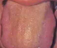 Understanding Tongue Diagnosis in Traditional Chinese Medicine (with Tongue Diagnosis Illustrations)