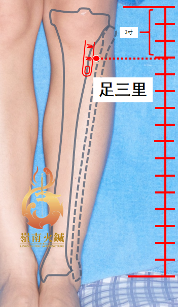 Lingnan Fire Needle Therapy for Post-New Year Food Accumulation