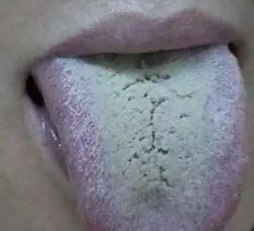 The Most Comprehensive Guide to Tongue Diagnosis! Master It and Become a Tongue Diagnosis Expert