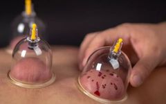 Definition and Functions of Bloodletting in Traditional Chinese Medicine
