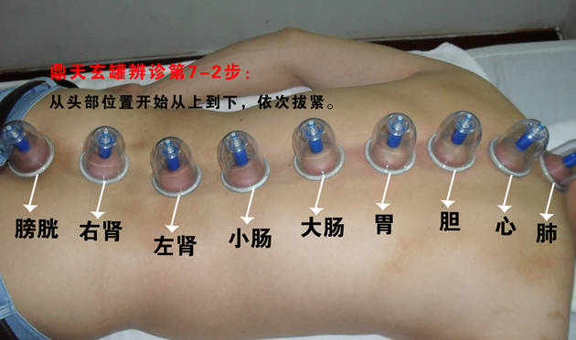 What Do Cupping Marks Indicate After Treatment?