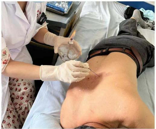Acupuncture Department II: What Conditions Can Fire Needle Therapy Treat?