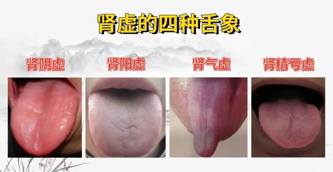 Four Types of Kidney Deficiency: Kidney Yin Deficiency, Kidney Yang Deficiency, Kidney Qi Deficiency, and Kidney Essence Deficiency - How to Choose the Right Herbal Medicine