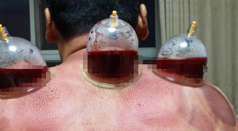 The Therapeutic Effects of Bloodletting in Traditional Chinese Medicine