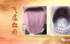 Symptoms of Qi Stagnation and Blood Stasis, and Their Regulation Methods