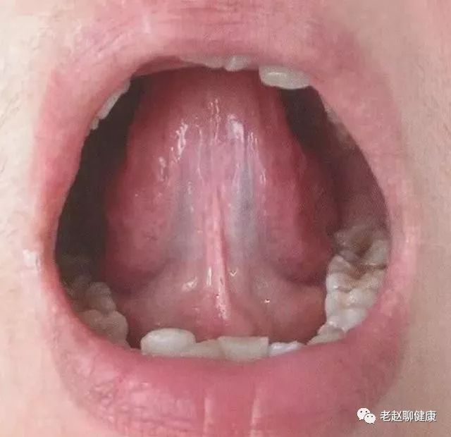 Tongue Diagnosis │ Sublingual Collaterals