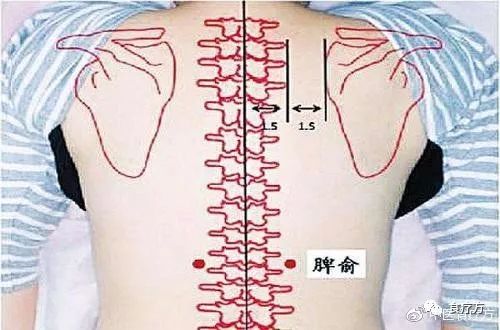 Comprehensive Guide to Cupping Therapy for the Back